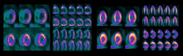 Medical imaging scans displaying multiple cross-sectional views of an organ, likely the heart, using color-coded PET or SPECT imaging.
