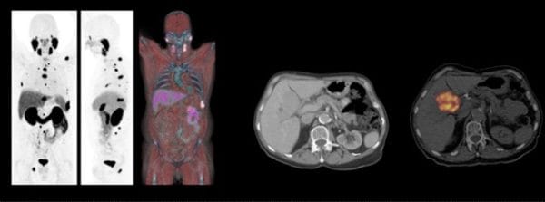 Medical imaging scans displaying full-body and cross-sectional views using PET/CT technology.