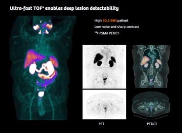 Ultra fast deep lesion detection
